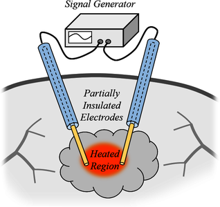 Simulation of RF Tissue Ablation